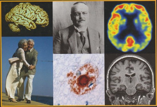 Atlas of Alzheimer's Disease — boekomslag